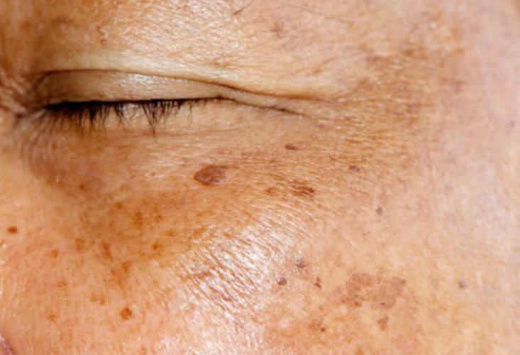 Everything you need to know about acne and effective treatments cover