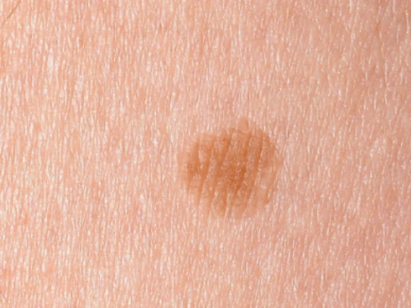 pigment roodheid