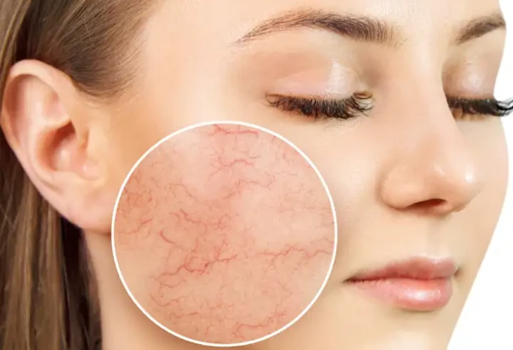 Everything you need to know about acne and effective treatments cover