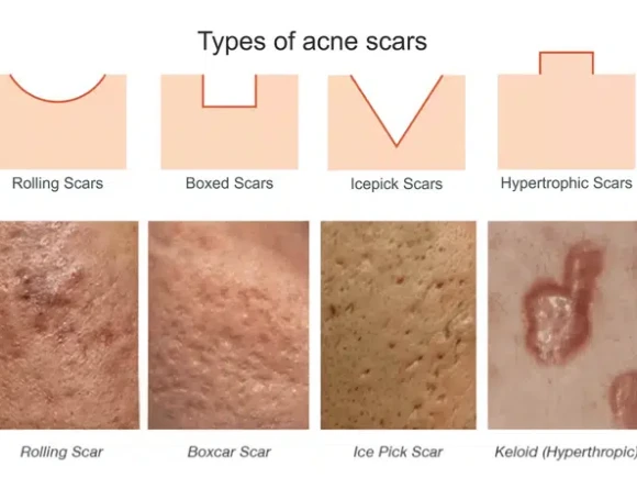 vitamine C peel voor na