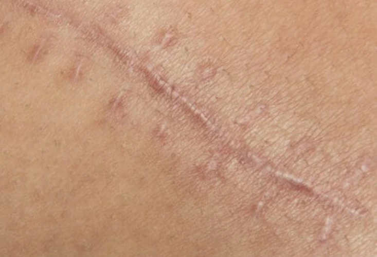 Everything you need to know about acne and effective treatments cover