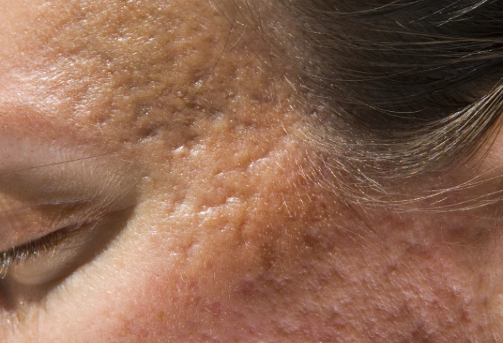 vitamin c summer peel