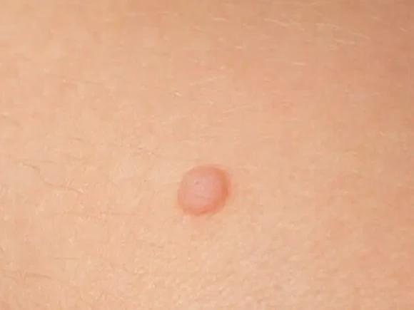 vitamin c summer peel