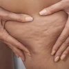 Everything you need to know about acne and effective treatments cover
