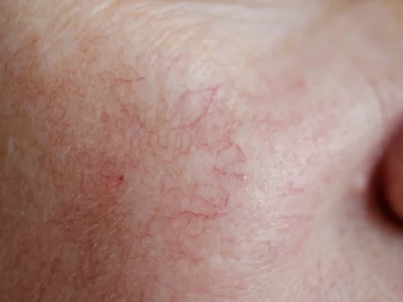Everything you need to know about acne and effective treatments cover