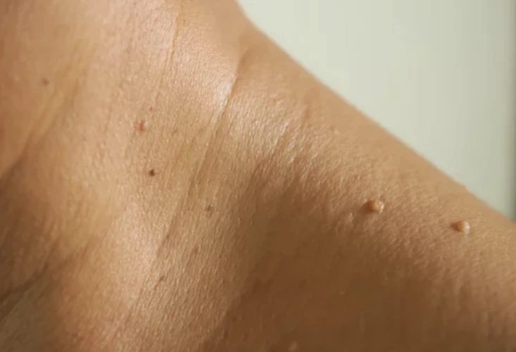 vitamin c summer peel
