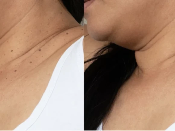 vitamine C peel voor na