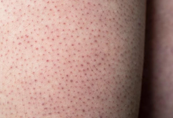 Everything you need to know about acne and effective treatments cover