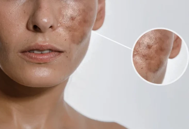 vitamin c summer peel