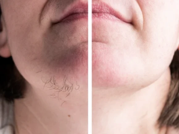 Everything you need to know about acne and effective treatments cover