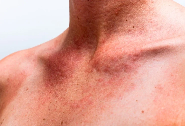 vitamin c summer peel