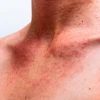 Everything you need to know about acne and effective treatments cover