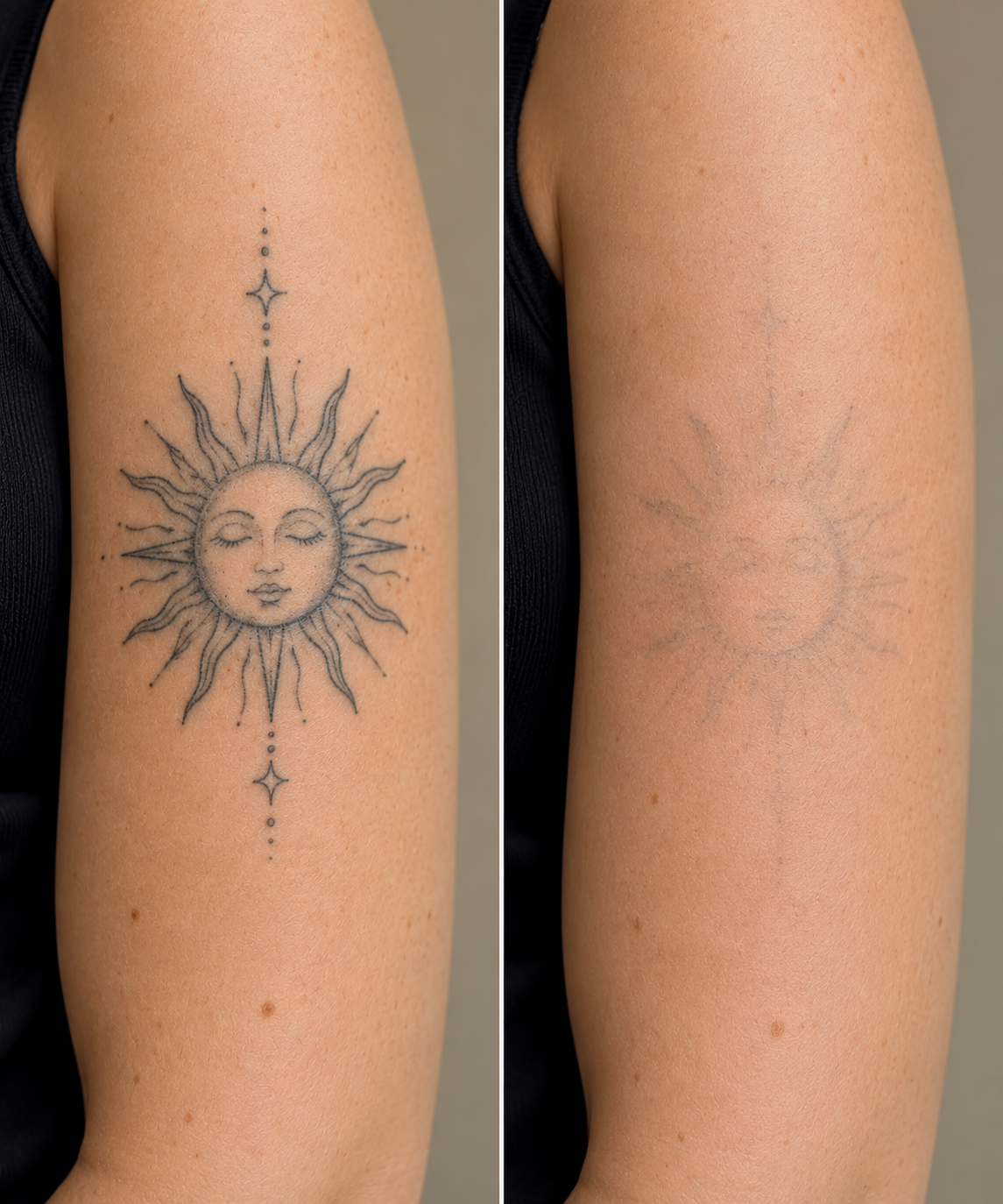 Tatoeage verwijderen met een picolaser: zo werkt het